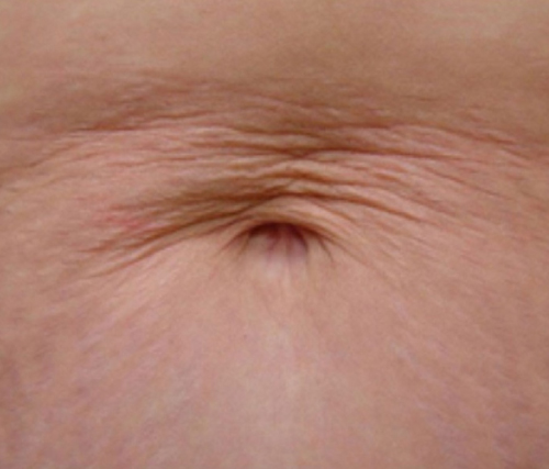 Before HydroFacial treatment at Le Vestige Aesthetics, showing uneven skin texture and dull complexion