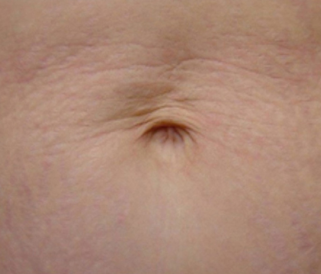 After HydroFacial treatment at Le Vestige Aesthetics, showing improved skin texture and a radiant, rejuvenated complexion