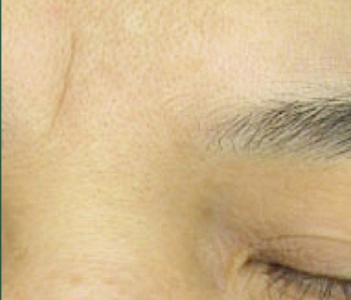 After wrinkle relaxer treatment showing softened glabellar lines and smoother forehead, achieving a more youthful appearance at Le Vestige Aesthetics
