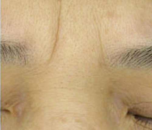 Before wrinkle relaxer treatment showing deep lines between eyebrows and horizontal forehead wrinkles at Le Vestige Aesthetics