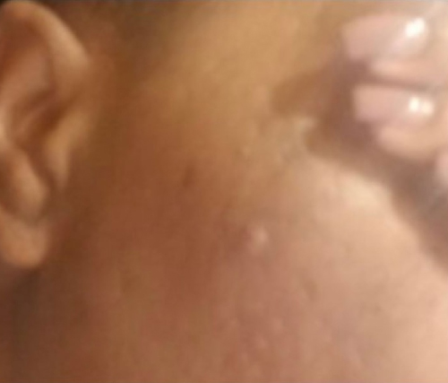 After wrinkle relaxer treatment at Le Vestige Aesthetics, showing smoother forehead and reduced crow's feet, demonstrating wrinkle reduction