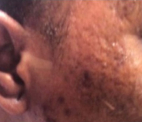 Before wrinkle relaxer treatment at Le Vestige Aesthetics, showing prominent forehead lines and crow's feet