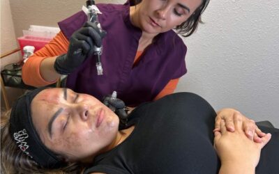 Benefits of Microneedling