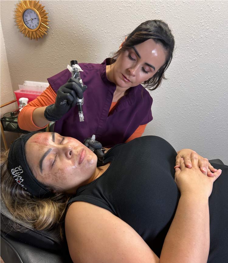 microneedling-treatment Microneedling