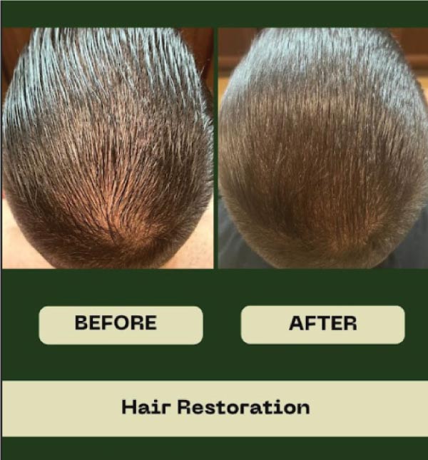 hair-restoration