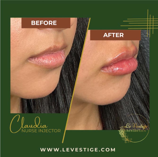 lip-enhacer lip filler in hanford, ca