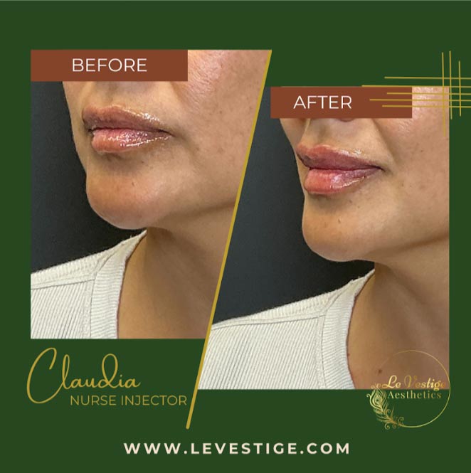lip-fillers lip enhacer in hanford, ca