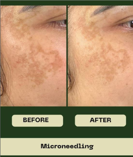 microneedling-before-and-afrer before and after microneedling
