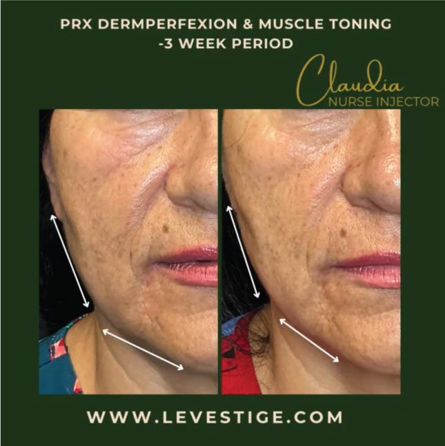 PRX Dermperfexion in hanford, ca