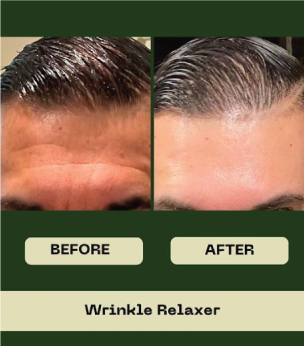 wrinkle relaxer in hanford, ca
