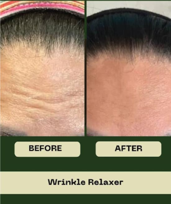wrinkle relaxer in hanford, ca