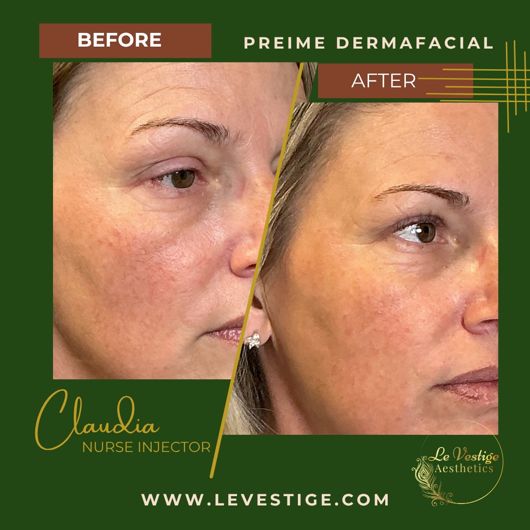 what is a facial: Before and after comparison of a Preime DermaFacial treatment showing visible skin rejuvenation and reduced redness at Le Vestige Aesthetics in Hanford.