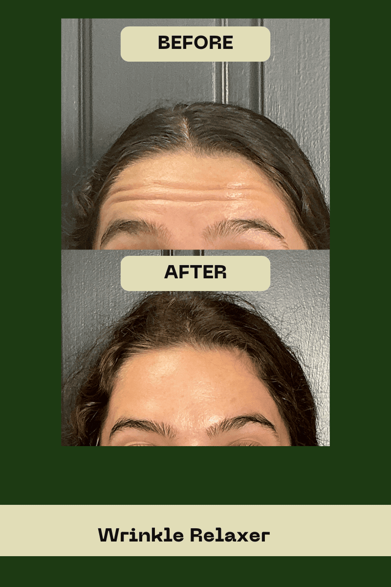 Before and after results for forehead rejuvenation using Botox or Jeuveau at Le Vestige Aesthetics, demonstrating the effective reduction of expression lines for a patient in the Central Valley