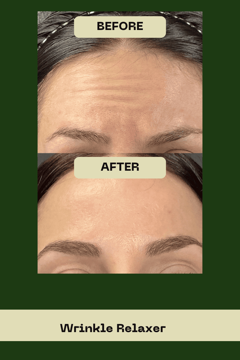 Close-up comparison of deep horizontal forehead creases before and after a wrinkle relaxer treatment at Le Vestige Aesthetics in Hanford, CA, highlighting smooth and youthful skin results