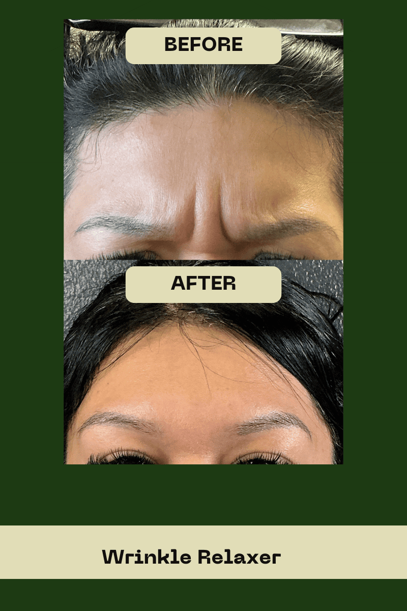 Close-up before and after of a female patient's glabellar lines (frown lines) treated with Botox at Le Vestige Aesthetics, demonstrating smooth skin between the eyebrows after neurotoxin injections