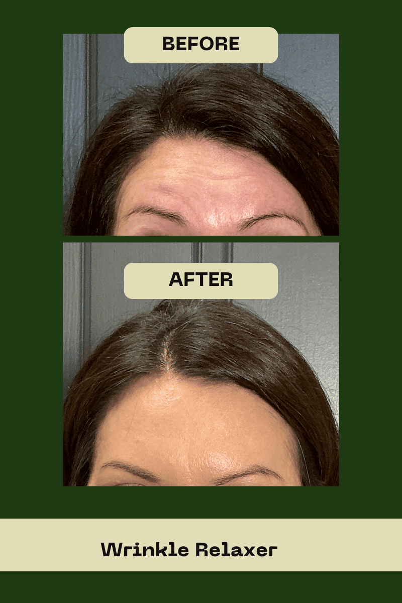 Jeuveau before and after results for a female patient at Le Vestige Aesthetics, illustrating the effective smoothing of forehead movement lines with this modern wrinkle relaxer alternative