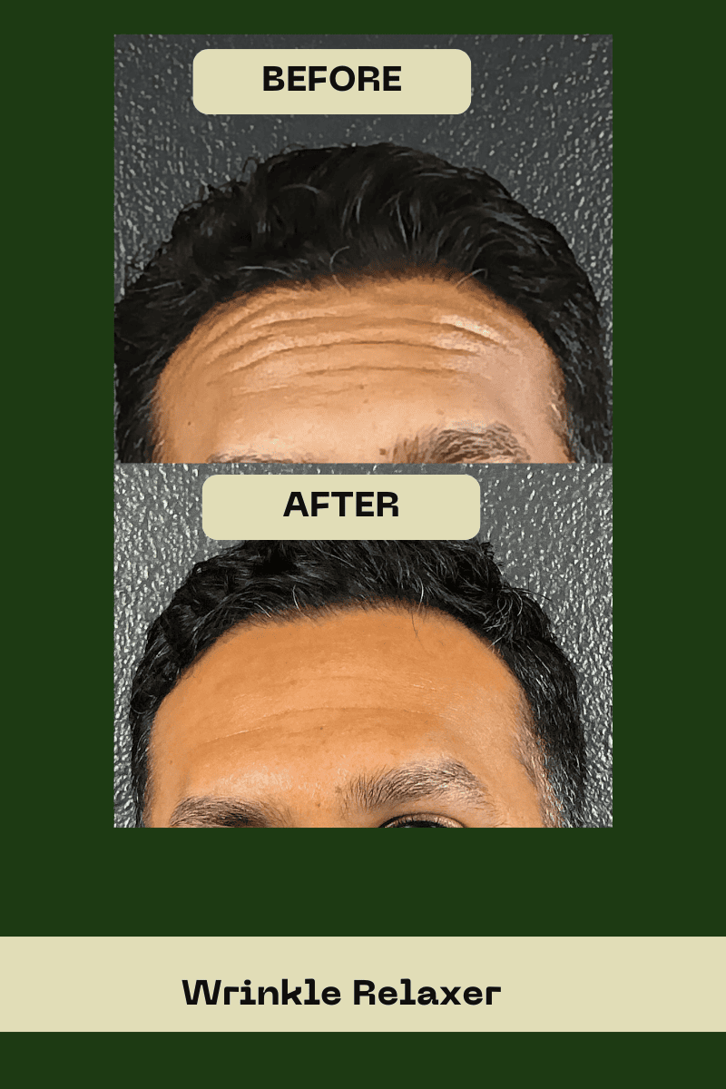 Before and after comparison of male forehead wrinkle relaxer treatment at Le Vestige Aesthetics in Hanford, CA, showing a significant reduction in deep horizontal forehead lines for a smoother, youthful look