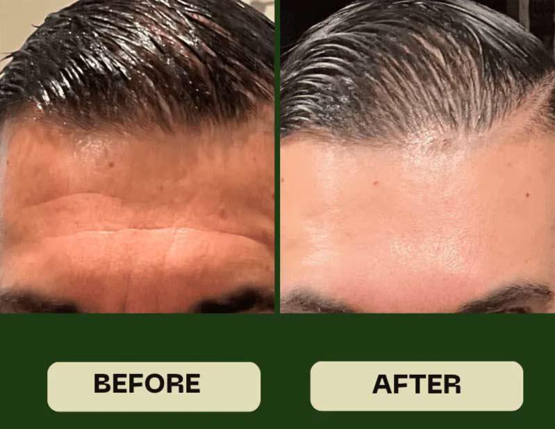 Male aesthetic treatment results showing before and after wrinkle relaxer injections for forehead rejuvenation in a private, comfortable Hanford MedSpa setting.