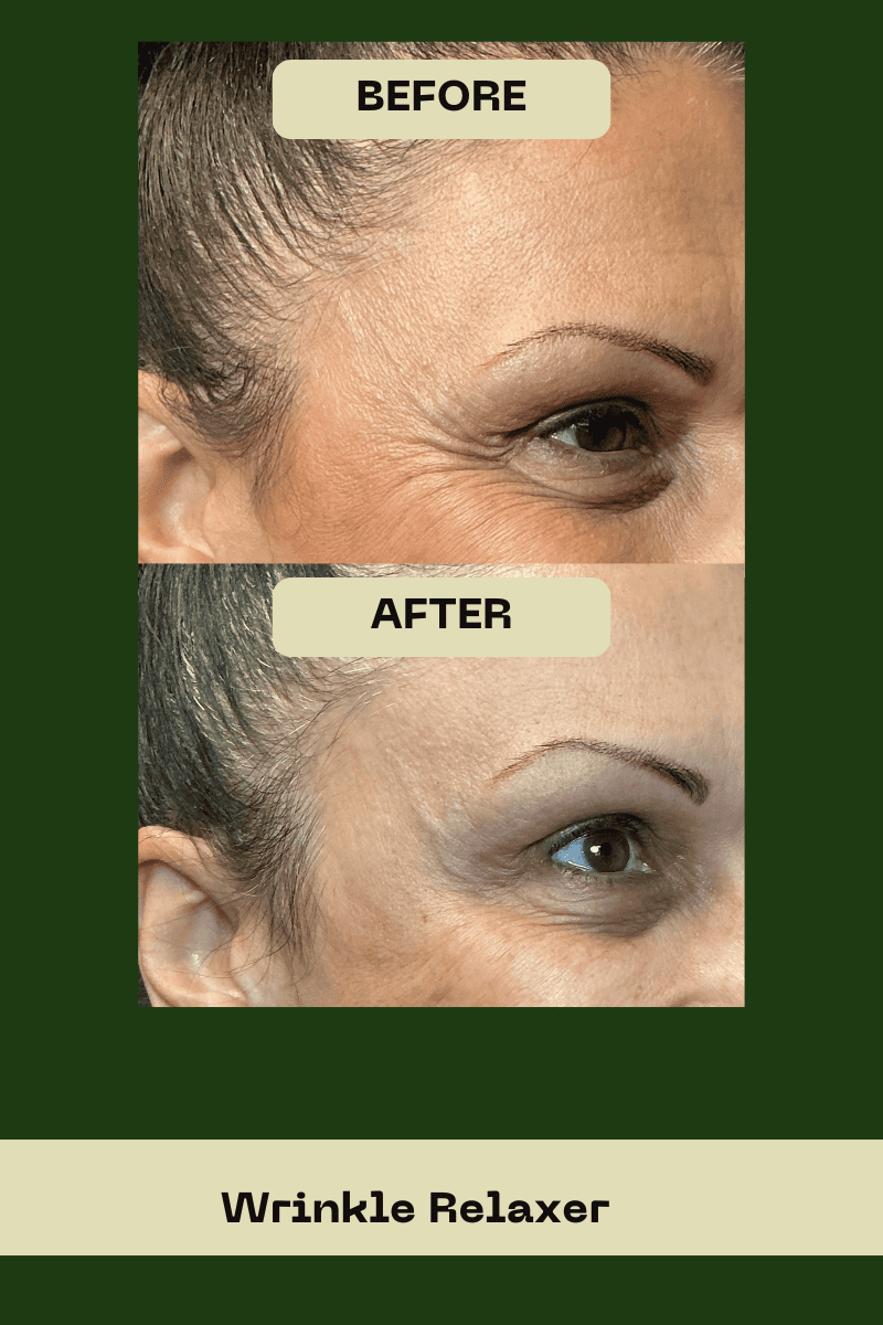 Side profile before and after of a patient's crow's feet and eye-area wrinkles treated with neurotoxins at Le Vestige Aesthetics, showing a significant softening of fine lines and a refreshed appearance