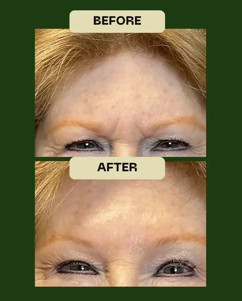 Effective reduction of crow's feet and forehead creases for an aging skin patient at Le Vestige Aesthetics, highlighting natural-looking results from personalized wrinkle relaxer sessions