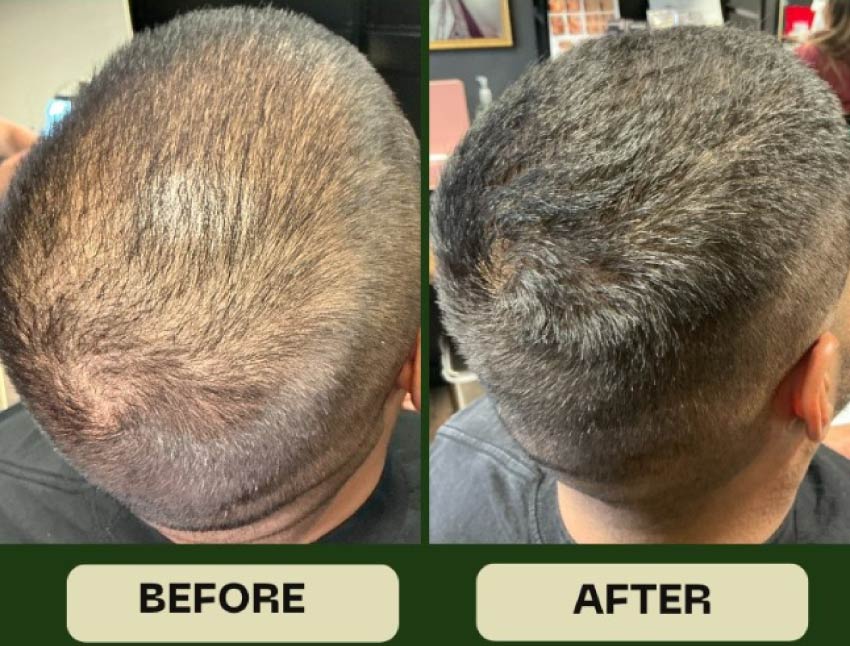 Before and after comparison of a Men's Hair Loss Treatment , showing significant hair restoration and increased density on the crown of the head