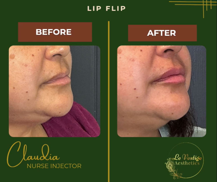 lip flip before and after image
