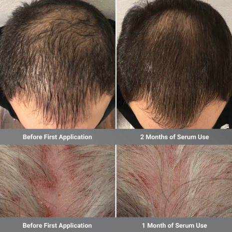 Before and after comparison of male hairline regrowth showing scalp progress after 1 and 2 months of serum treatment.